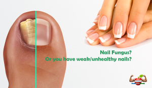 Nail Fungus